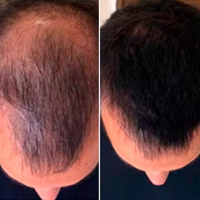 Customer photo review of SKALPURE® – Corrector Capilar Profesional