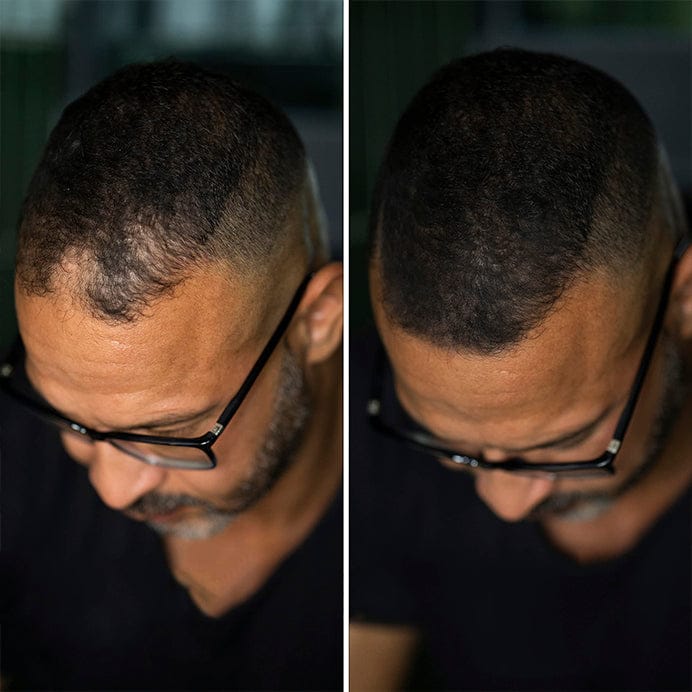 Customer photo review of SKALPURE® – Corrector Capilar Profesional