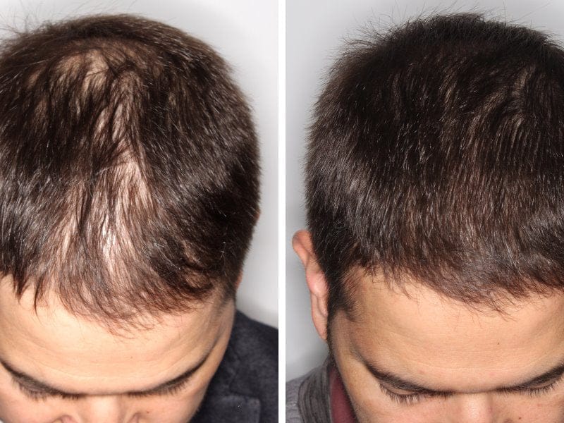 Customer photo review of SKALPURE® – Corrector Capilar Profesional