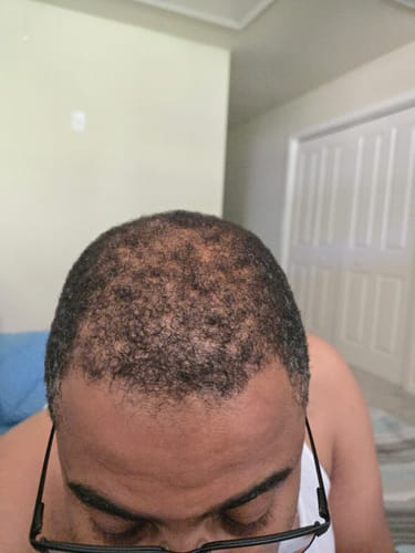 Customer photo review of Rennora Hair Growth Serum