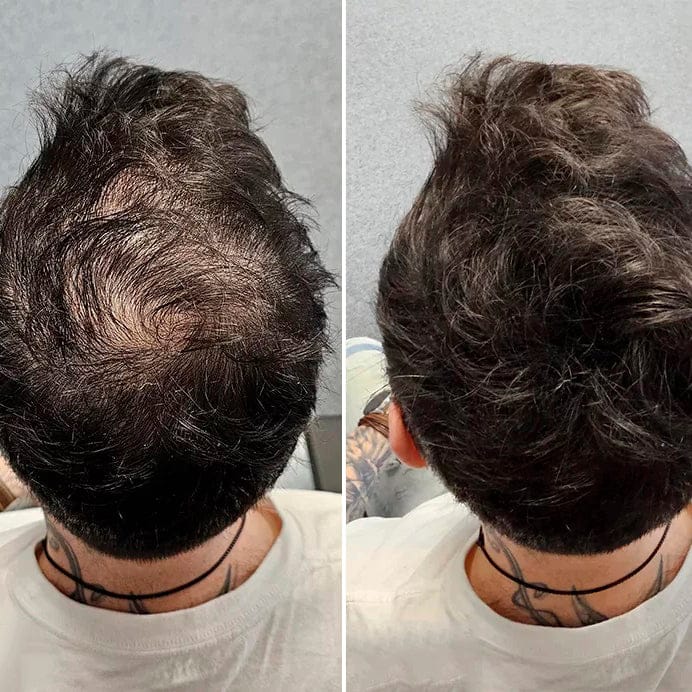Customer photo review of SKALPURE® – Corrector Capilar Profesional