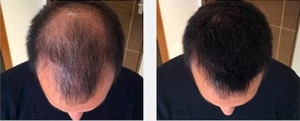 Customer photo review of SKALPURE® – Corrector Capilar Profesional