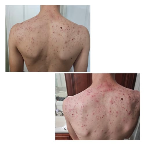 Customer photo review of The Complete Acne Stopper Starter Pack