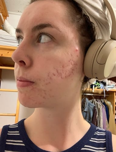 Customer photo review of The Complete Acne Stopper Starter Pack
