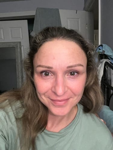 Customer photo review of The Complete Acne Stopper Starter Pack