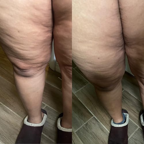 Customer photo review of Nuvex™️ Anti Cellulite Massage Oil