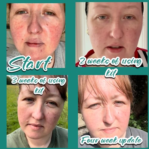 Customer photo review of 5-Step Clear Skin Kit