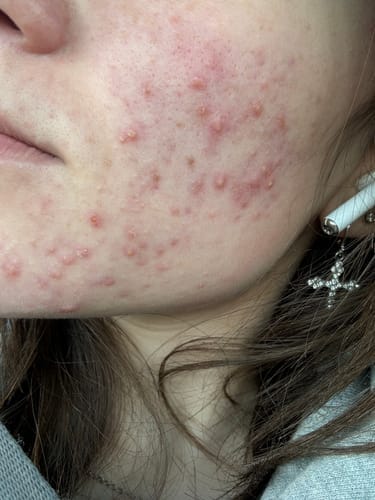 Customer photo review of The Complete Acne Stopper Starter Pack