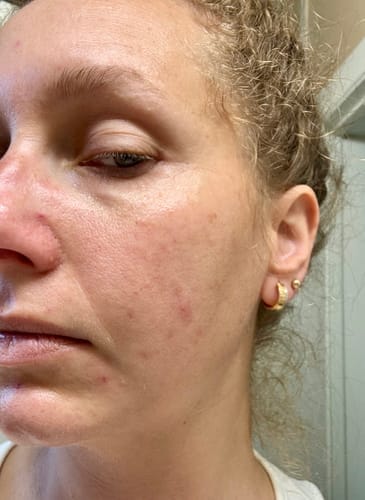 Customer photo review of The Complete Acne Stopper Starter Pack