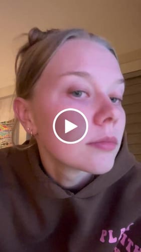 Customer photo review of The Complete Acne Stopper Starter Pack