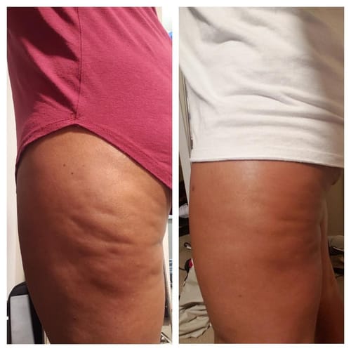 Customer photo review of Nuvex™️ Anti Cellulite Massage Oil