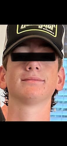 Customer photo review of The Complete Acne Stopper Starter Pack