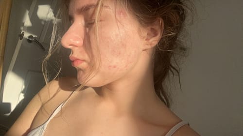 Customer photo review of The Complete Acne Stopper Starter Pack