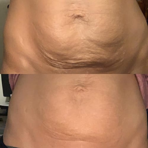 Customer photo review of Nuvex™️ Anti Cellulite Massage Oil