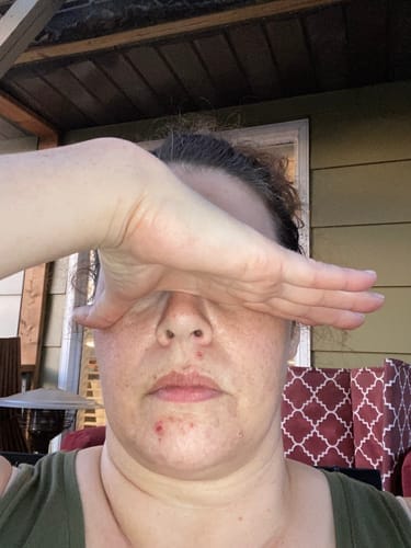 Customer photo review of The Complete Acne Stopper Starter Pack
