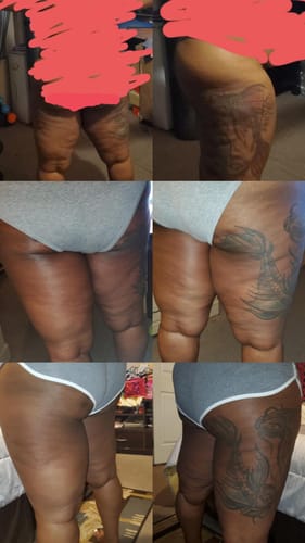 Customer photo review of Nuvex™️ Anti Cellulite Massage Oil