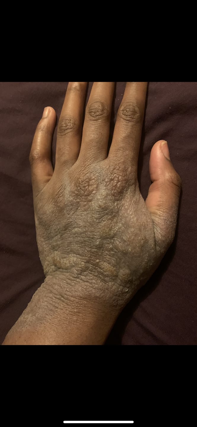 Customer photo review of Large Bioskin Duo Pack