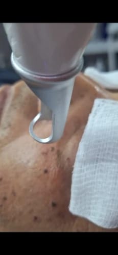 Customer photo review of Neatcell™ – Picosecond Laser Remover For Tattoos & Spots