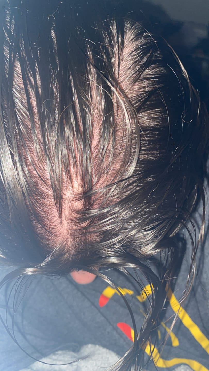 Customer photo review of Rosemary Elixir - 100% Natural Hair Loss Solution