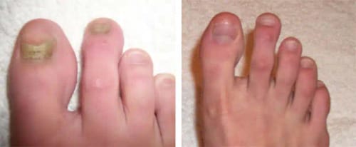 Customer photo review of FungalFix™️ - Nail Rescue Kit