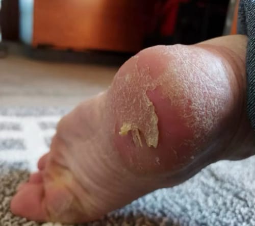 Customer photo review of Buy 1 Get 1 Foot Care Cream