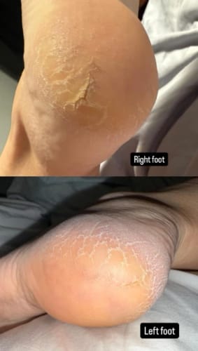 Customer photo review of Buy 1 Get 1 Foot Care Cream