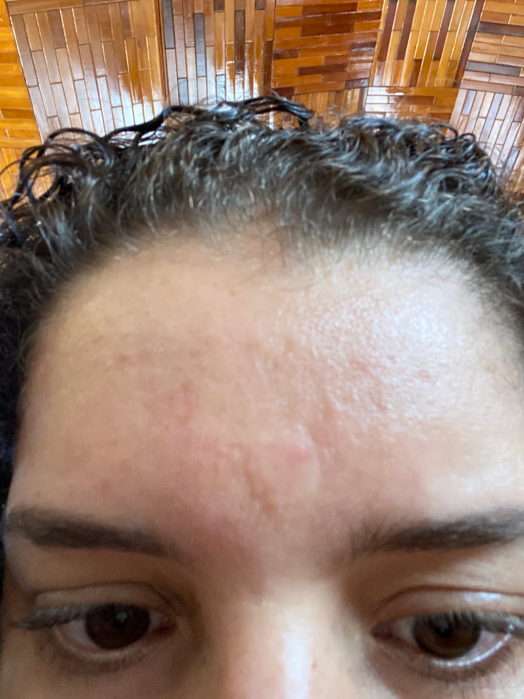 Customer photo review of Isntree - Onion Newpair Spot Patch Skin Fit