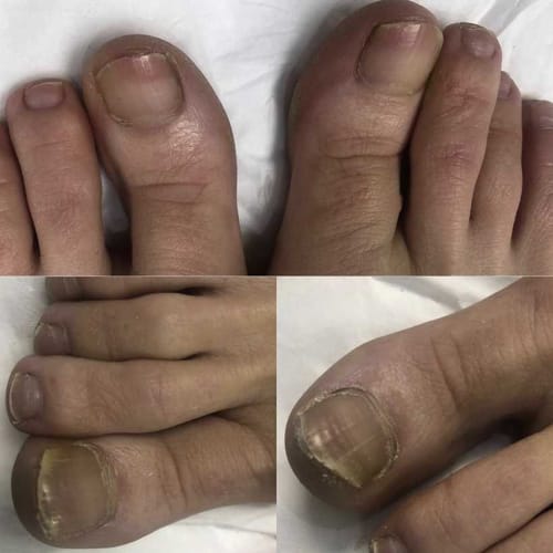 Customer photo review of FungalFix™ - Fungal Nail Renewal Patches