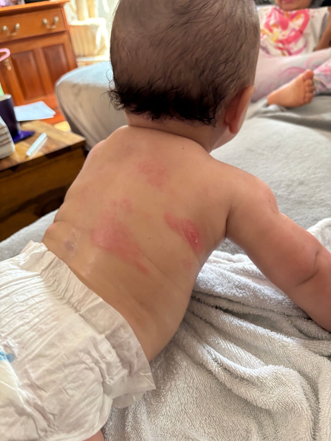 Customer photo review of Bioskin Junior Outbreak Rescue Cream