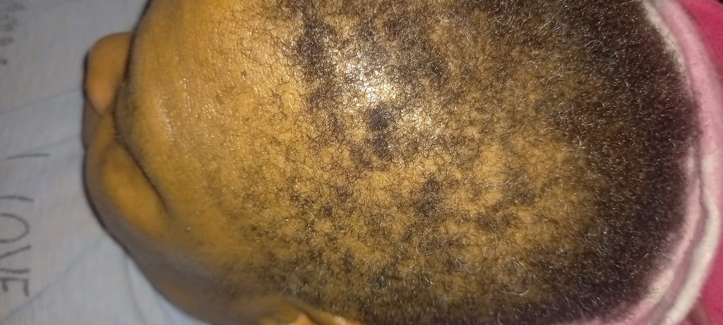 Customer photo review of New Formula: Root Stimulating Serum (50ml)
