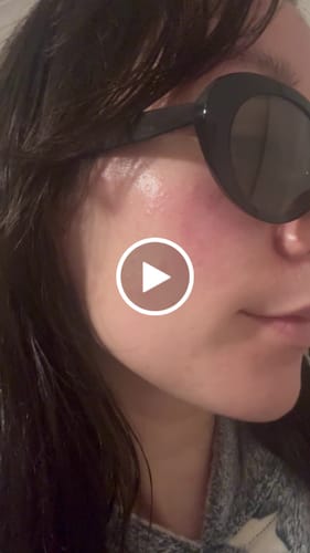 Customer video review of Intermediate Acne Program™