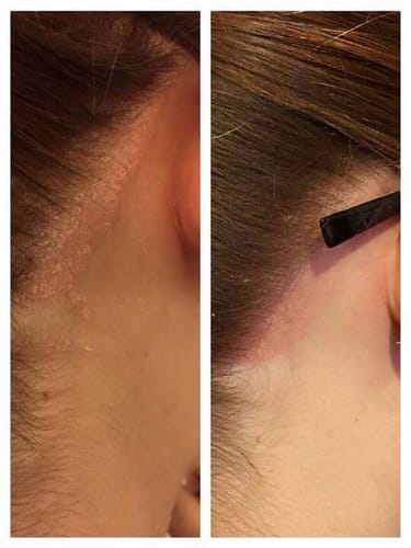 Customer photo review of Pack Caspa Seca y Psoriasis: Shampoo Hidratante + Tónico Calmante para caspa seca, picazón o brotes