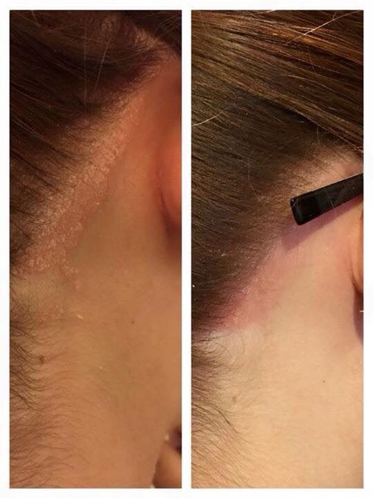 Customer photo review of Pack Caspa Seca y Psoriasis: Shampoo Hidratante + Tónico Calmante para caspa seca, picazón o brotes