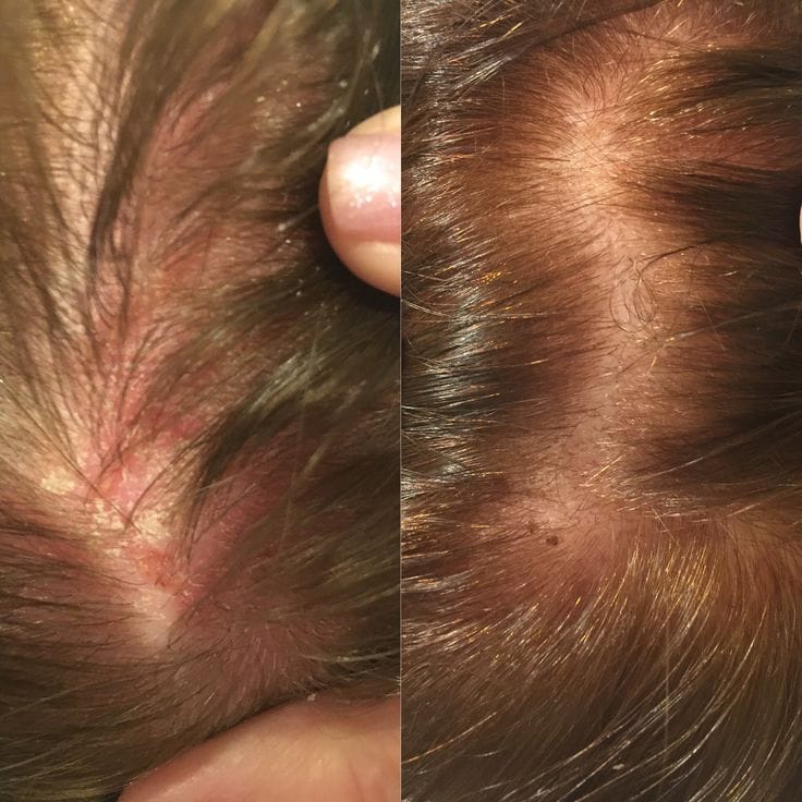 Customer photo review of Pack Caspa Seca y Psoriasis: Shampoo Hidratante + Tónico Calmante para caspa seca, picazón o brotes