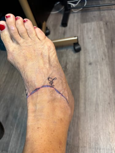 Customer photo review of Painless Tattoo 3 Pack