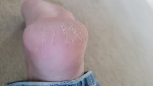 Customer photo review of F-Balm - Anti-Aging Tallow Balm - Black Label (UNSCENTED)