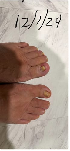 Customer photo review of Pentachom Antifungal Laser Program