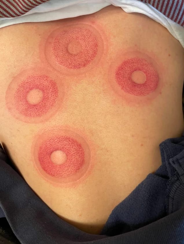 Customer photo review of CUPPING MASSAGE JARS