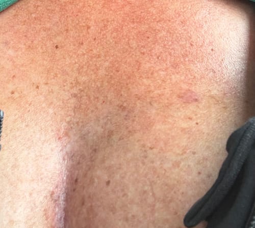 Customer photo review of Radiation Relief Cream – Unscented Burn Cream for Radiation Therapy