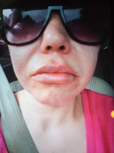 Customer photo review of LipFix: Filler