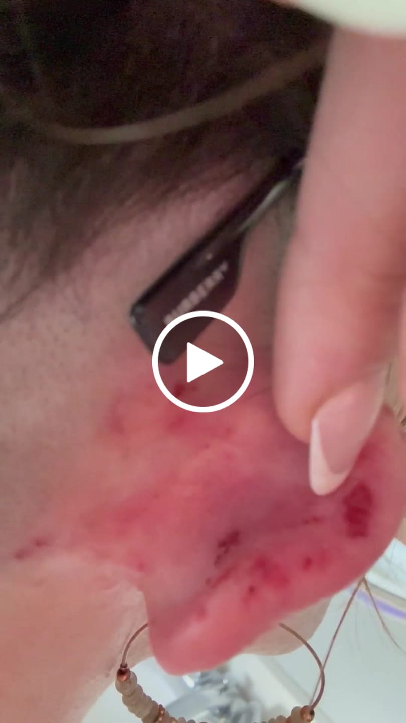 Customer video review of Natural Grade Bee Venom Therapy Kit