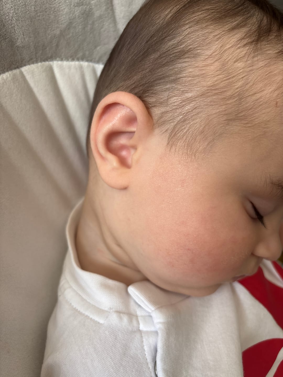Customer photo review of Bioskin Junior Outbreak Rescue Cream