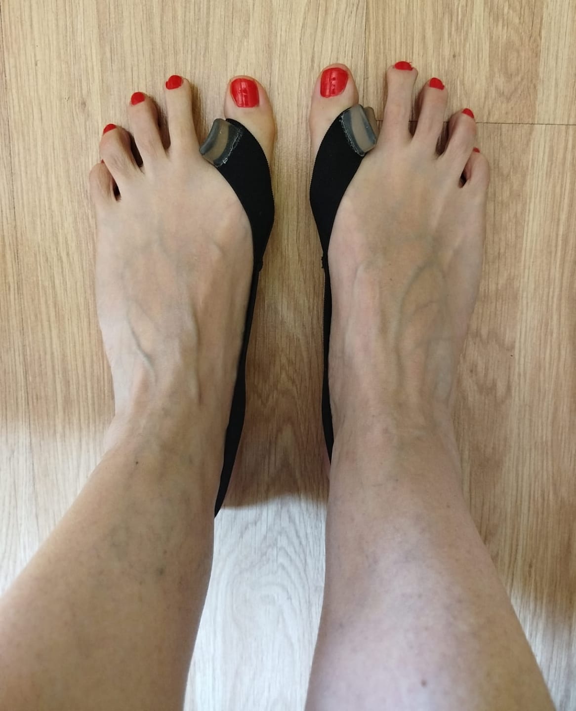 Customer photo review of Banda correctora de Juanetes