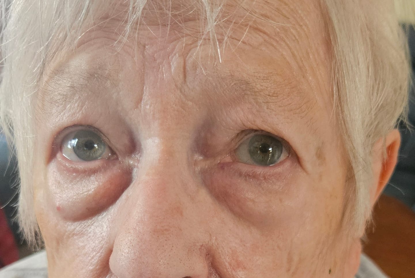 Customer photo review of EYEBAGHACK -  Express Eyelift Effect