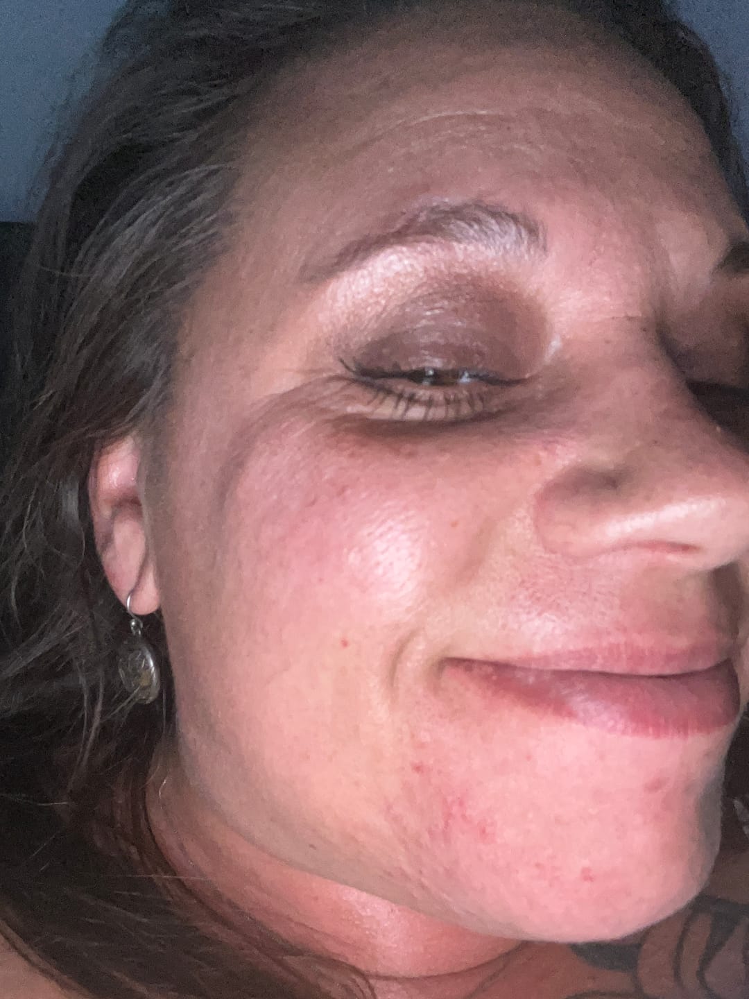 Customer photo review of Osmosis Skincare Rescue MD Epidermal Repair Serum