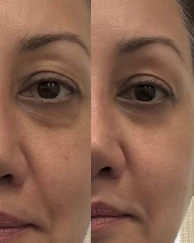 Customer photo review of EvenSkyn® Venus: Advanced Eyelid Anti-Aging Device