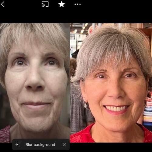 Customer photo review of EvenSkyn® Lumo⁺: Premium Anti-Aging & Skin Tightening Handset