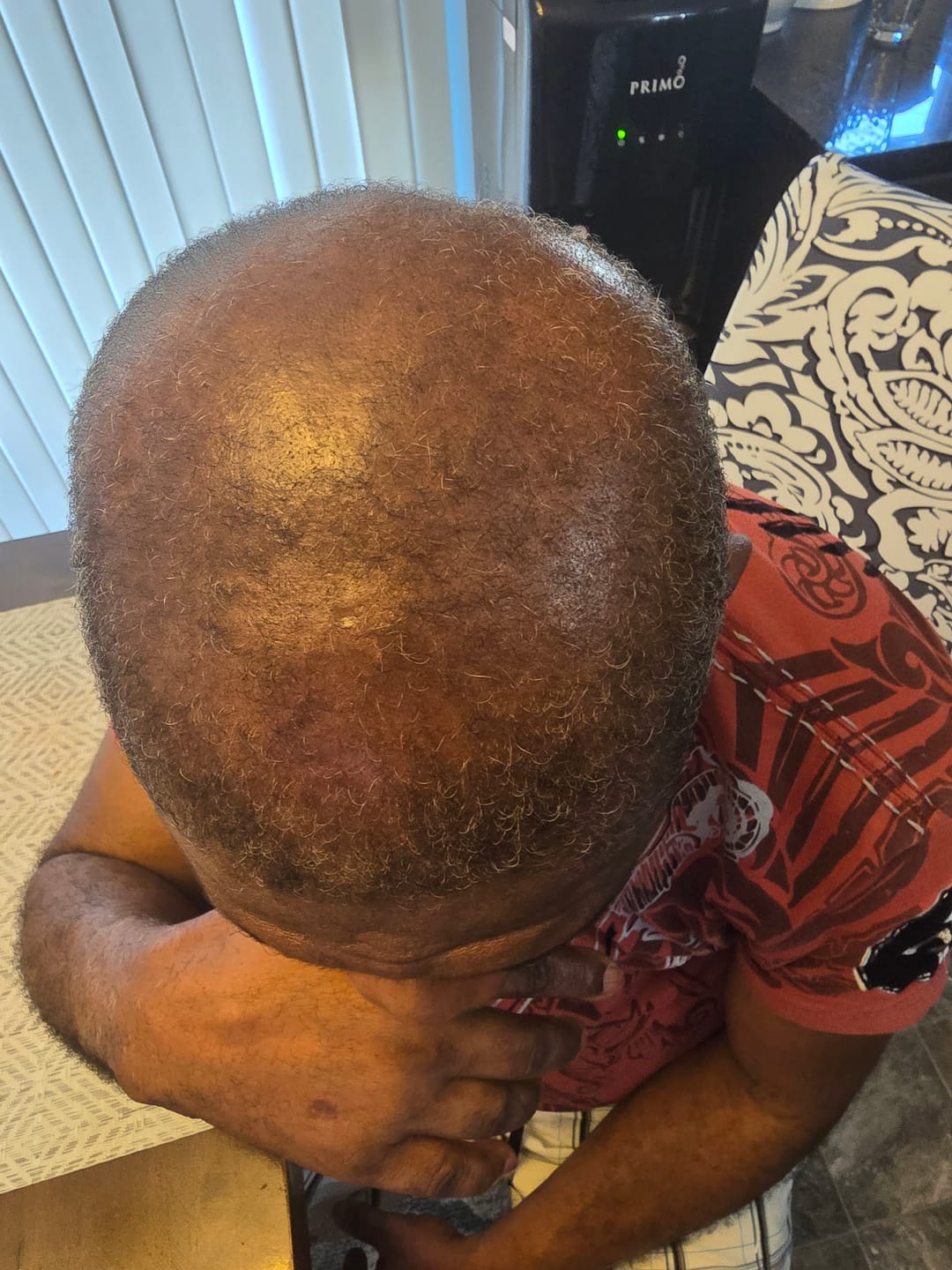 Customer photo review of Novaxidil Triple Therapy Hair Regrowth Foam
