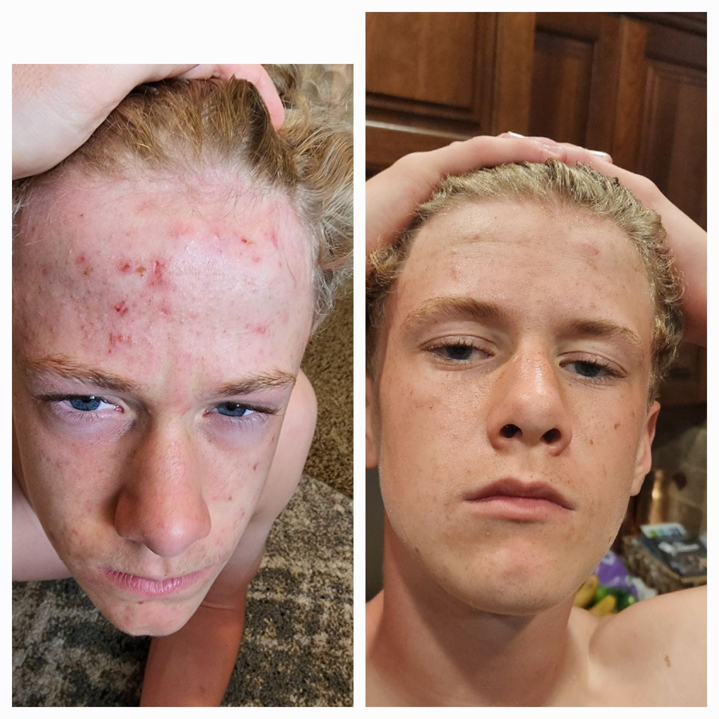 Customer photo review of Kill Acne & Redness Ritual