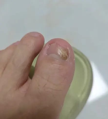 Customer photo review of FungalFix™ - Fungal Nail Renewal Patches